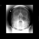 Fracture of the zygomatico-maxillary complex, right side, hemosinus: X-ray - Plain radiograph